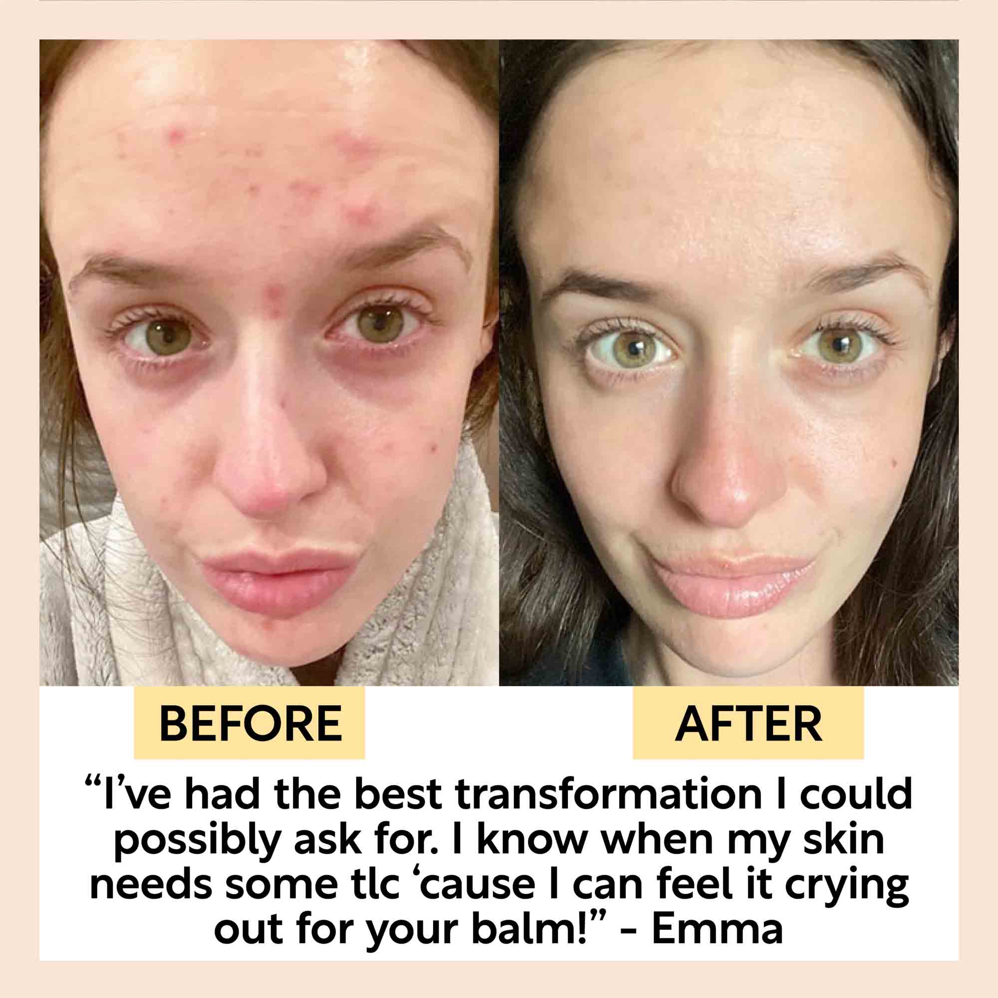 Acne-Prone Skincare Bundle - Image 7